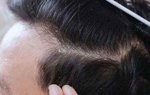 داروهای خانگی سریع برای شوره سر داروهای خانگی سریع برای شوره سر